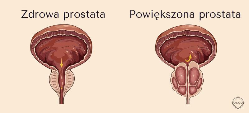 PSA całkowite a wolne